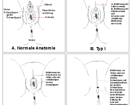 Beschneidungsformen (nach WHO) – Anatomie: A normale Anatomie, B Klitorisvorhaut und ggf. Klitoris wurden entfernt, C Klitorisvorhaut und ggf. Klitoris sowie die inneren Schamlippen wurden entfernt, D Klitorisvorhaut und Klitoris sowie die Schamlippen wurden entfernt und die Vaginalöffnung teilweise zugenäht